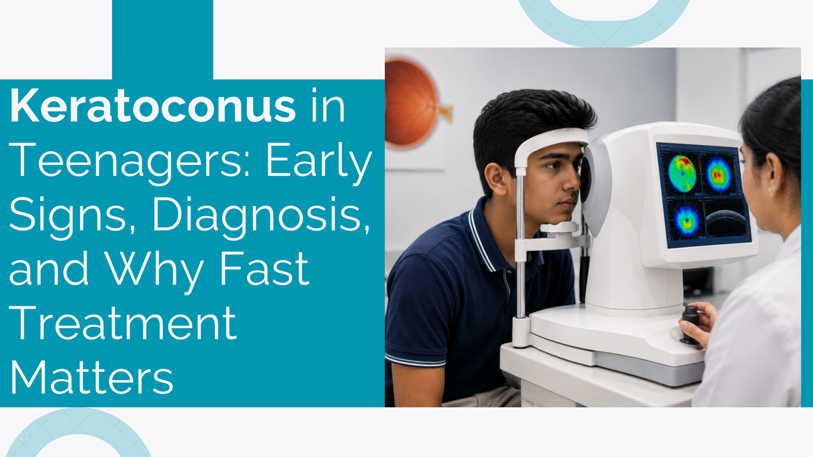 Home 13 Keratoconus In Teenagers Early Signs, Diagnosis, And Why Fast Treatment Matters